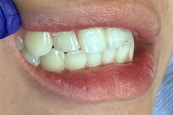 After-fracture-tooth-ec