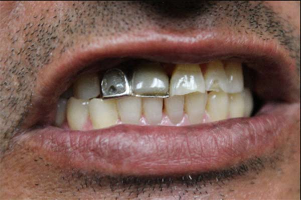 Before-fracture-crown