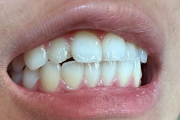 Before-fracture-tooth-ec