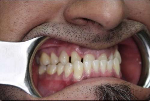 Implant-7-1
