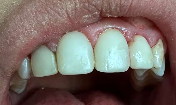 after-composite-veneer