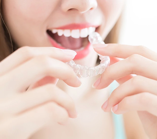 braces alternatives for teens clear aligners