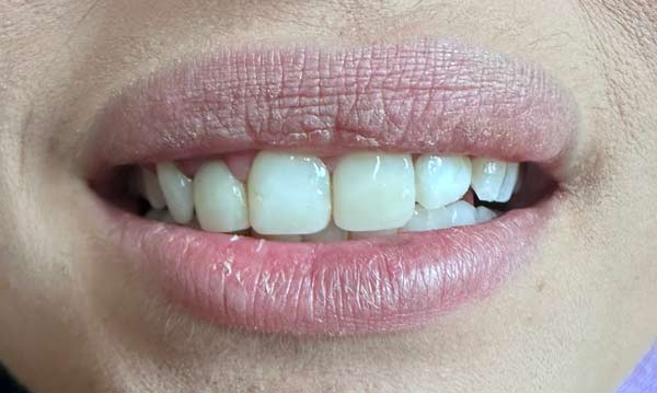 before-composite-veneer