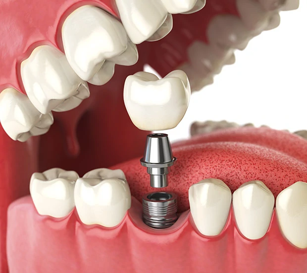 bone graft for dental implants procedure