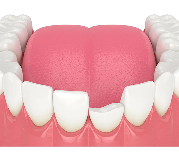 chipped tooth treatment repair dentist