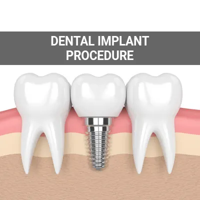 dental implant procedure step by step