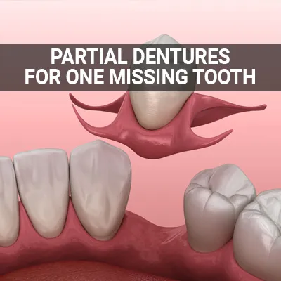 partial denture for one missing tooth solution