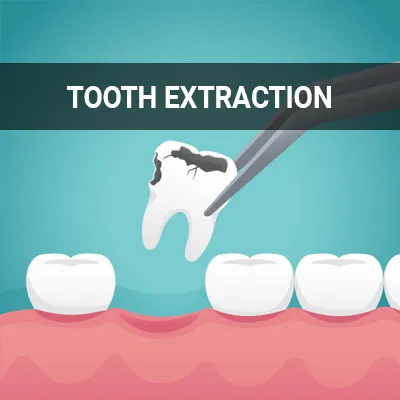 tooth extraction dental procedure clinic