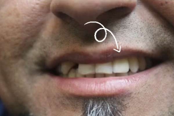 veneer-op