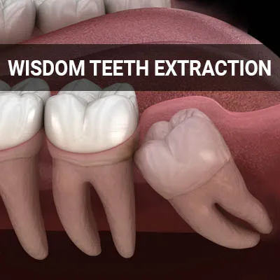 wisdom teeth extraction dental procedure