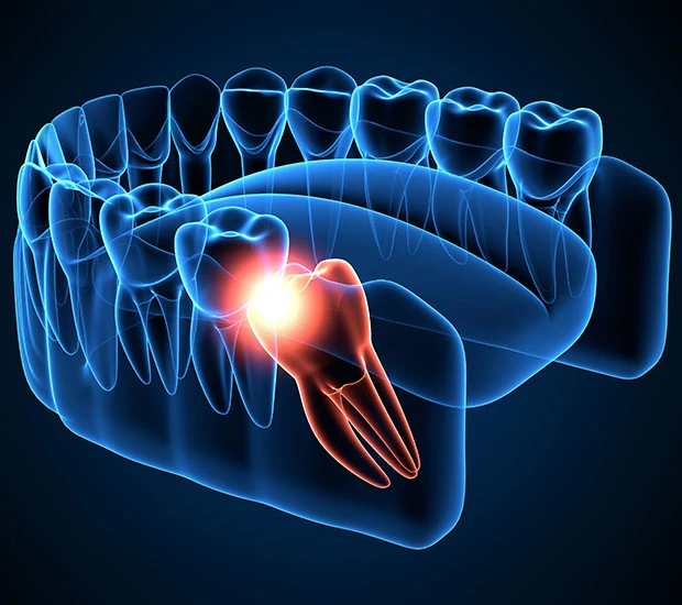wisdom teeth extraction procedure dentist